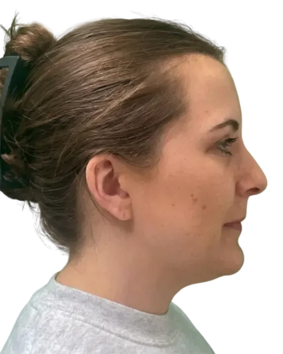 Rhinoplasty Before & After before image