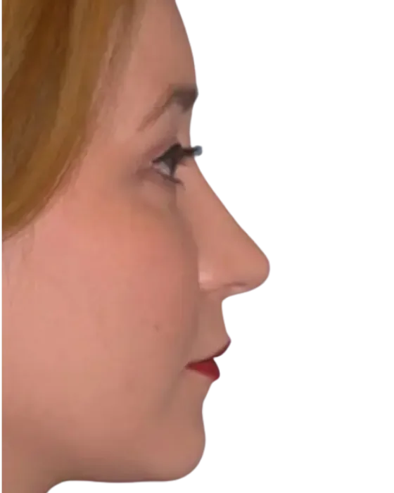 Rhinoplasty Before & After after image