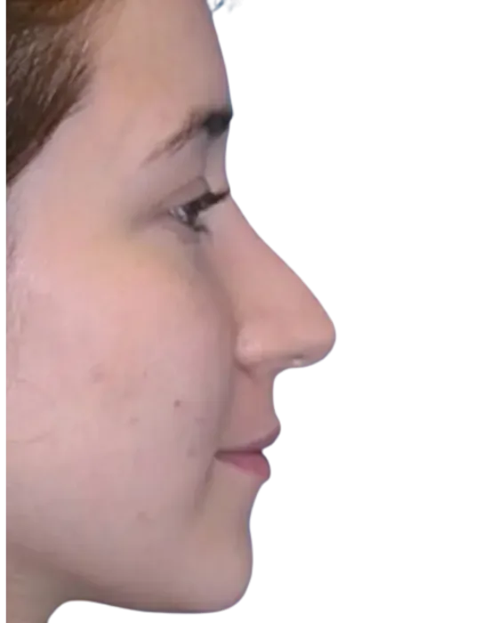 Rhinoplasty Before & After before image