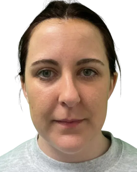 Rhinoplasty Before & After before image