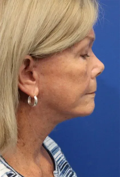 Case 5425 after image