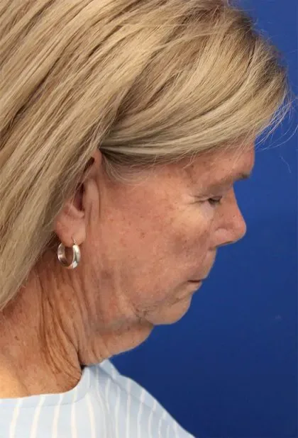Case 5425 before image