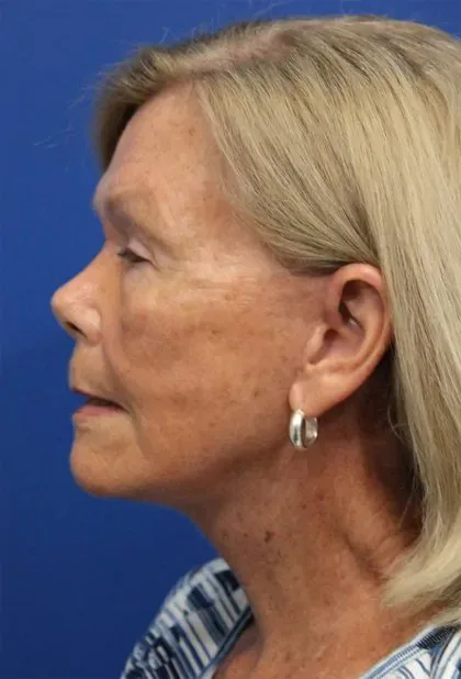 Case 5425 after image