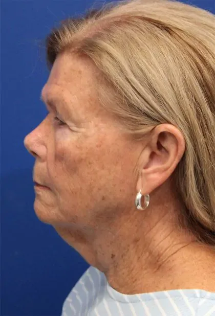 Case 5425 before image