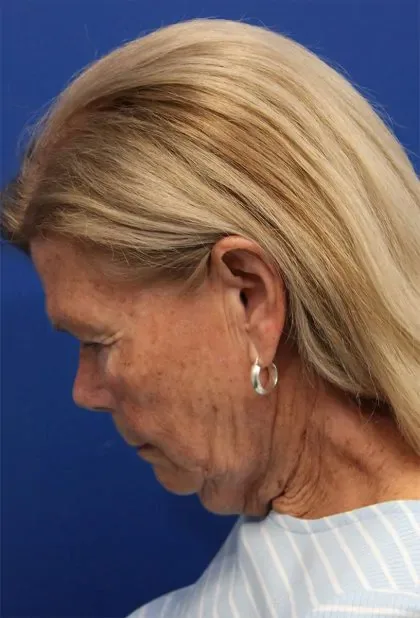 Case 5425 before image