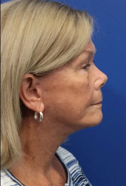 Case 5425 after image