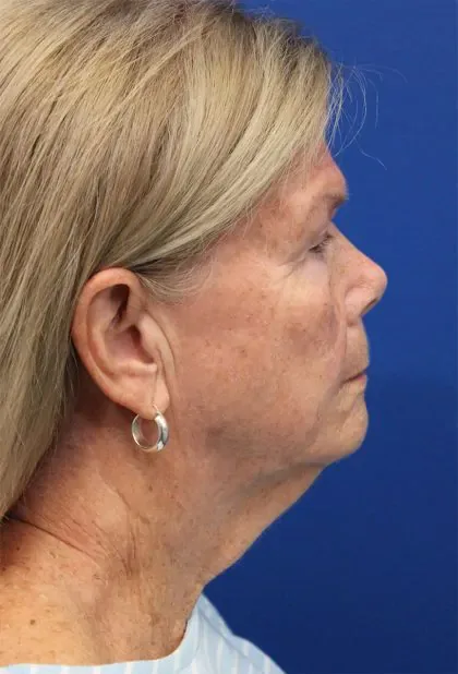 Case 5425 before image