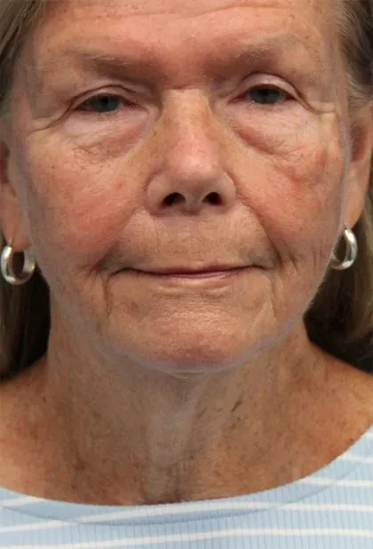 Case 5425 before image