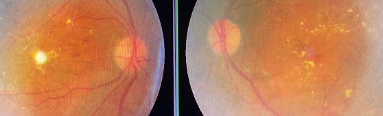 黄斑部周囲に硬性白斑がみられる糖尿病網膜症の参考眼底画像