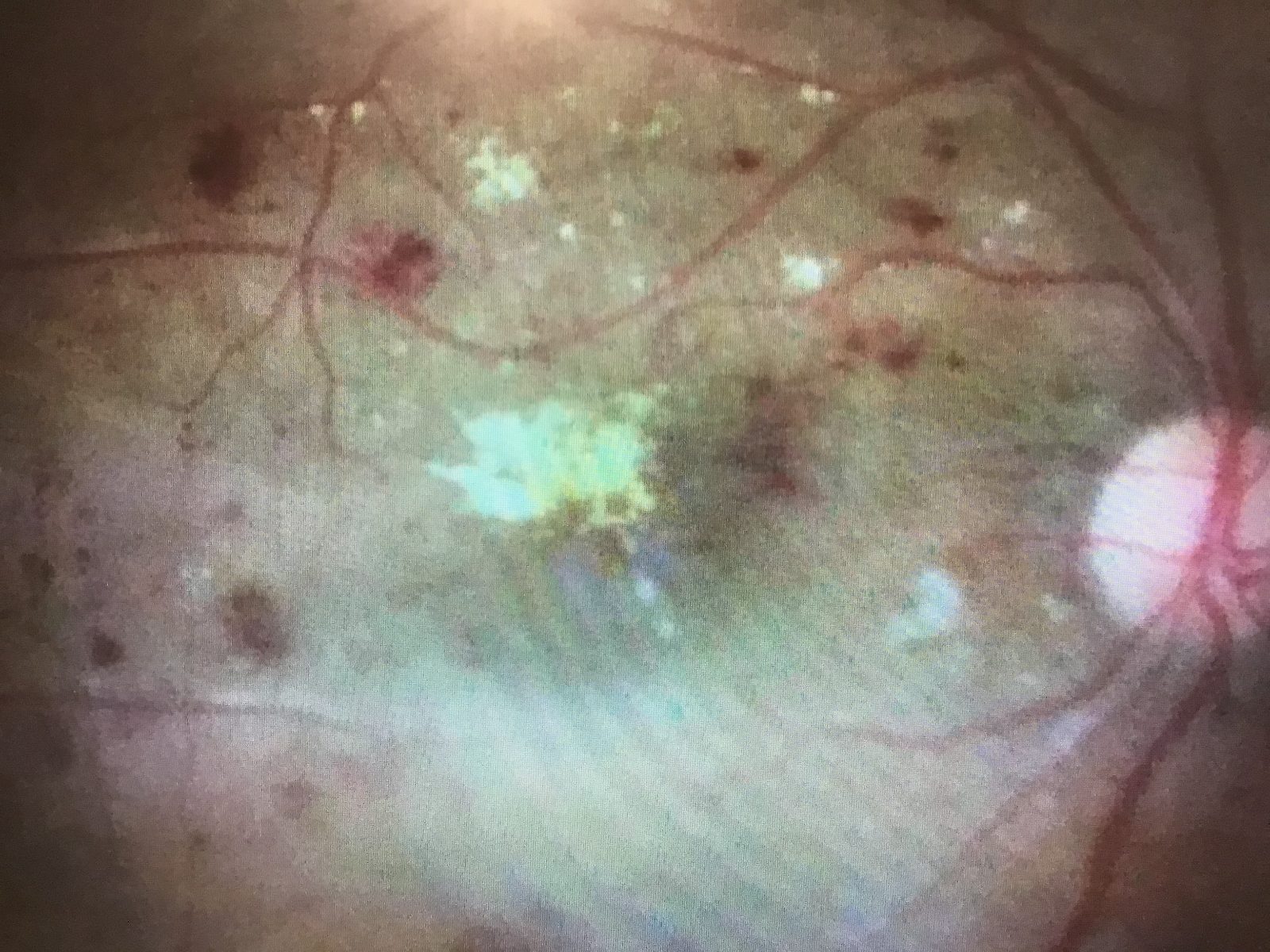 糖尿病網膜症の眼底参考画像