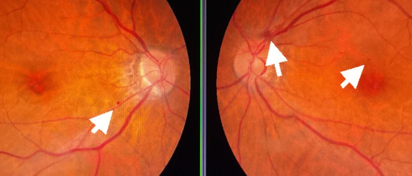 糖尿病網膜症でみられる点状・斑状出血の眼底画像