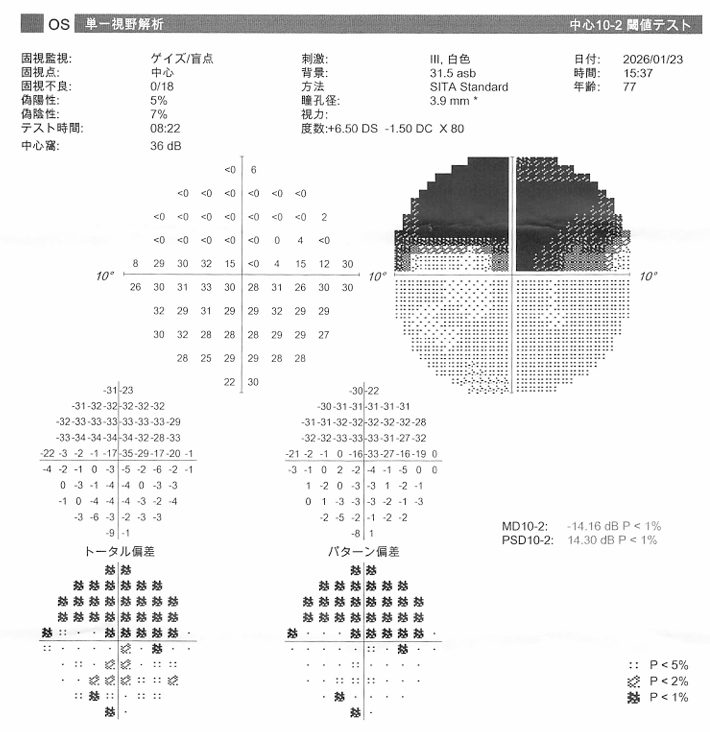 緑内障のハンフリー視野検査結果