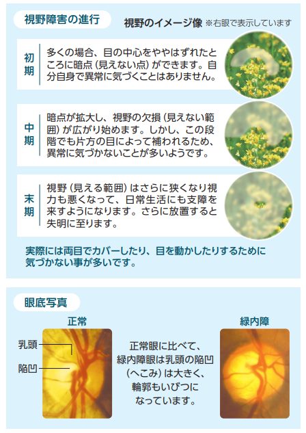 緑内障の進行に伴う視野障害の変化を示した参考図