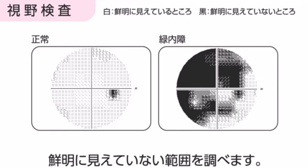 正常な視野と視野障害がある場合の見え方を比較した説明図