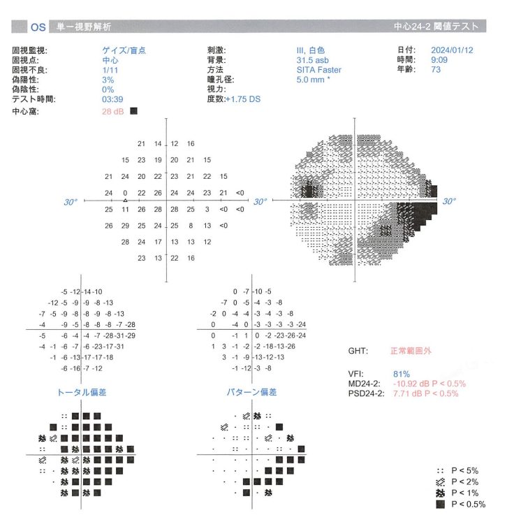 MDやVFIなどが表示された静的視野検査結果の参考画像