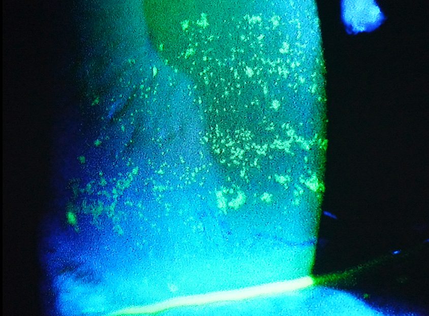 フルオレセイン染色で多数の角膜上皮障害が見える参考画像