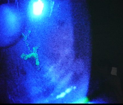 樹枝状に染色される角膜病変の参考画像