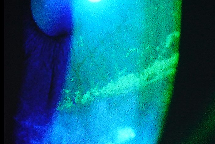 フルオレセイン染色で広い角膜上皮障害が確認できる参考画像