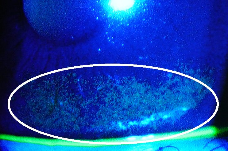 フルオレセイン染色で角膜表面の点状障害が強調された参考画像