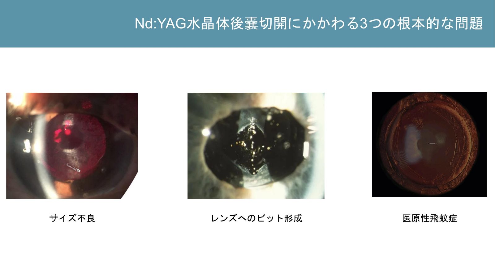 後嚢切開のサイズ、眼内レンズへのレーザー痕、膜片による飛蚊症の例
