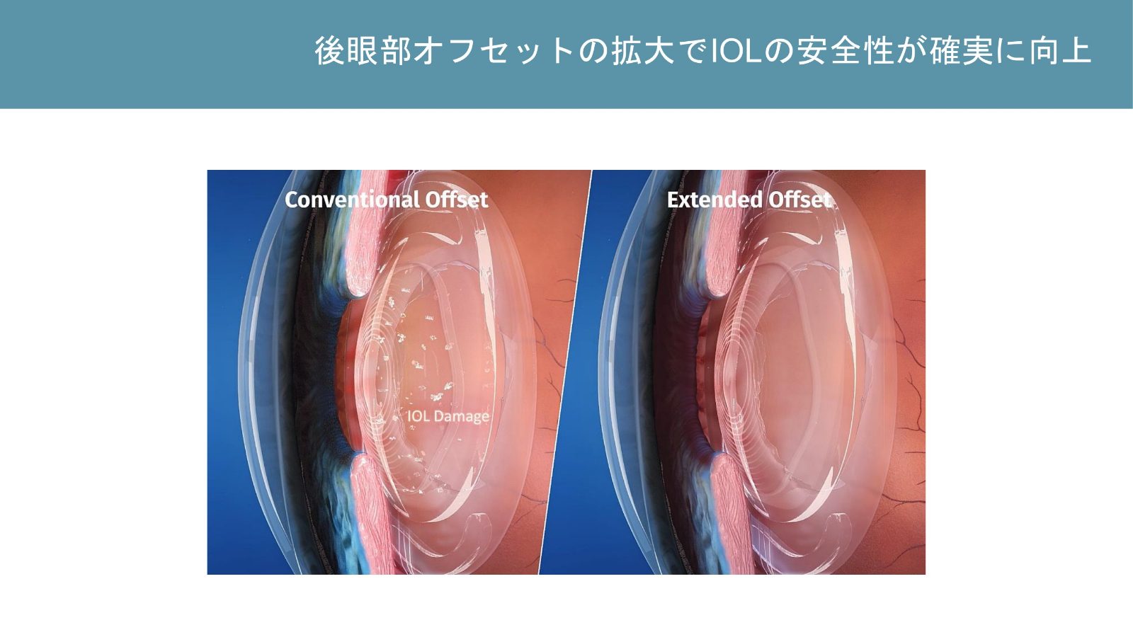 従来のレーザー焦点と眼内レンズより後方へ焦点を移した状態の比較図