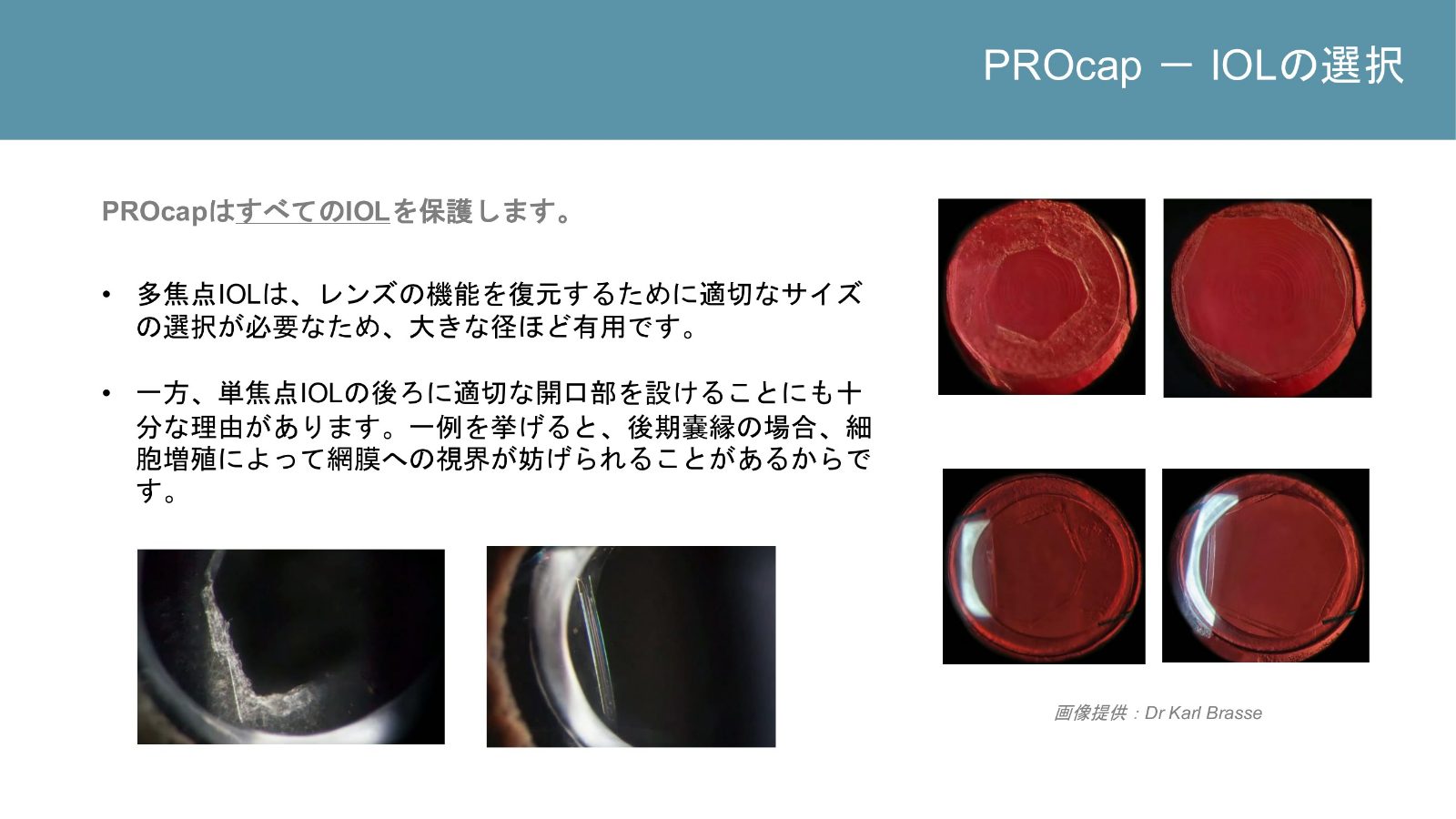 多焦点眼内レンズと単焦点眼内レンズで検討する後嚢切開径を示す資料