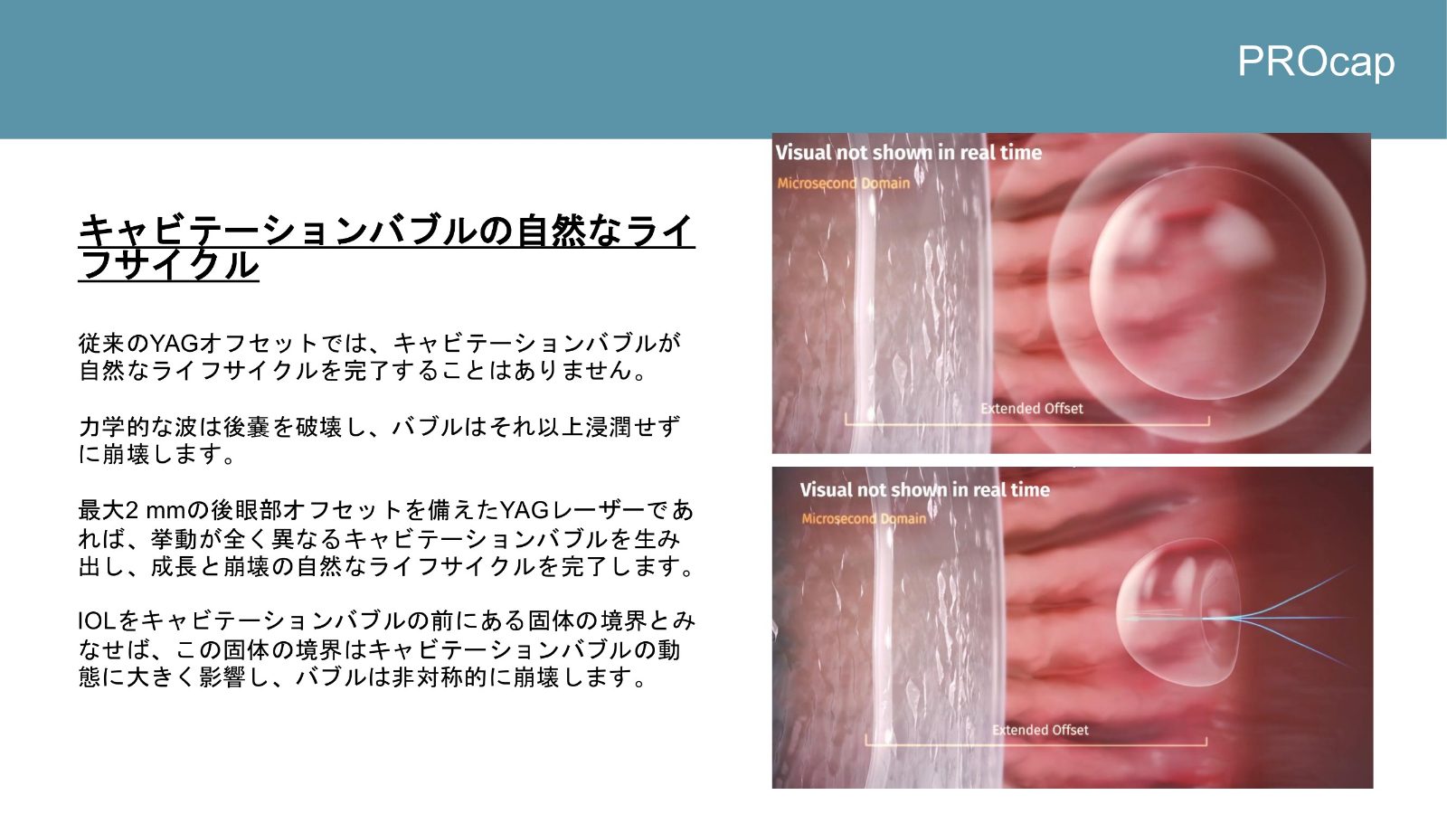 眼内レンズより後方でキャビテーションバブルが成長し崩壊する模式図