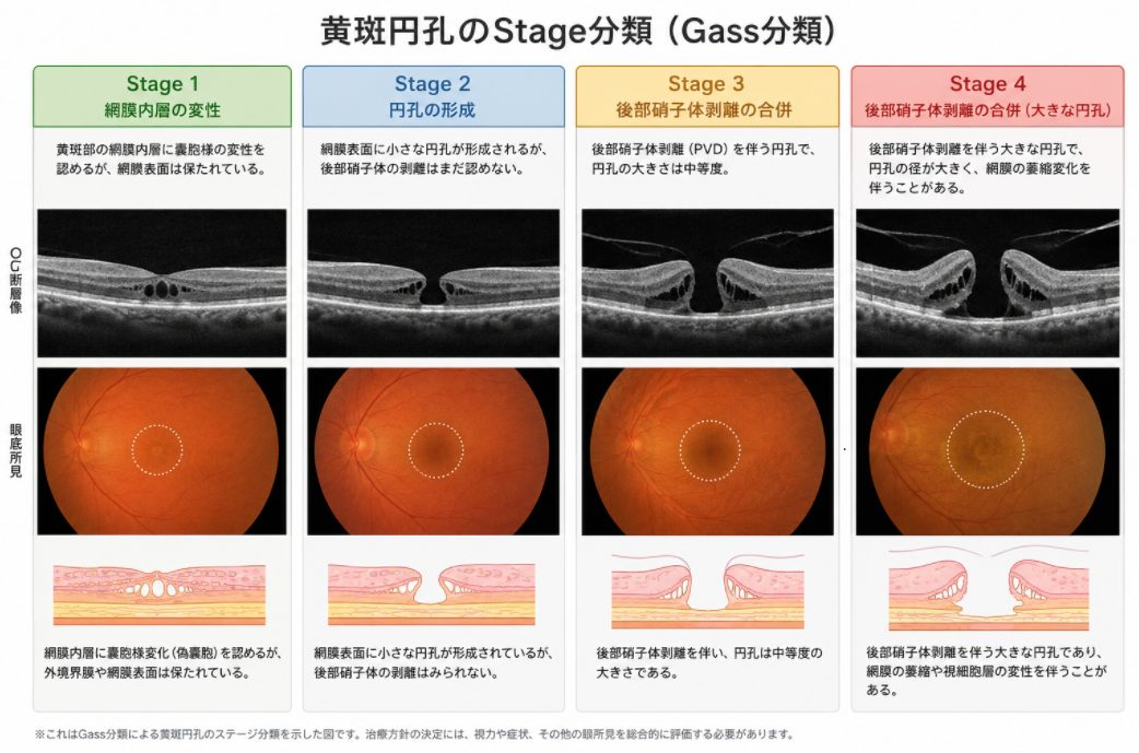 OCT画像、眼底写真、模式図で示した黄斑円孔のStage1からStage4までの分類