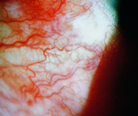 強膜周囲の深い血管拡張がみられる前眼部写真