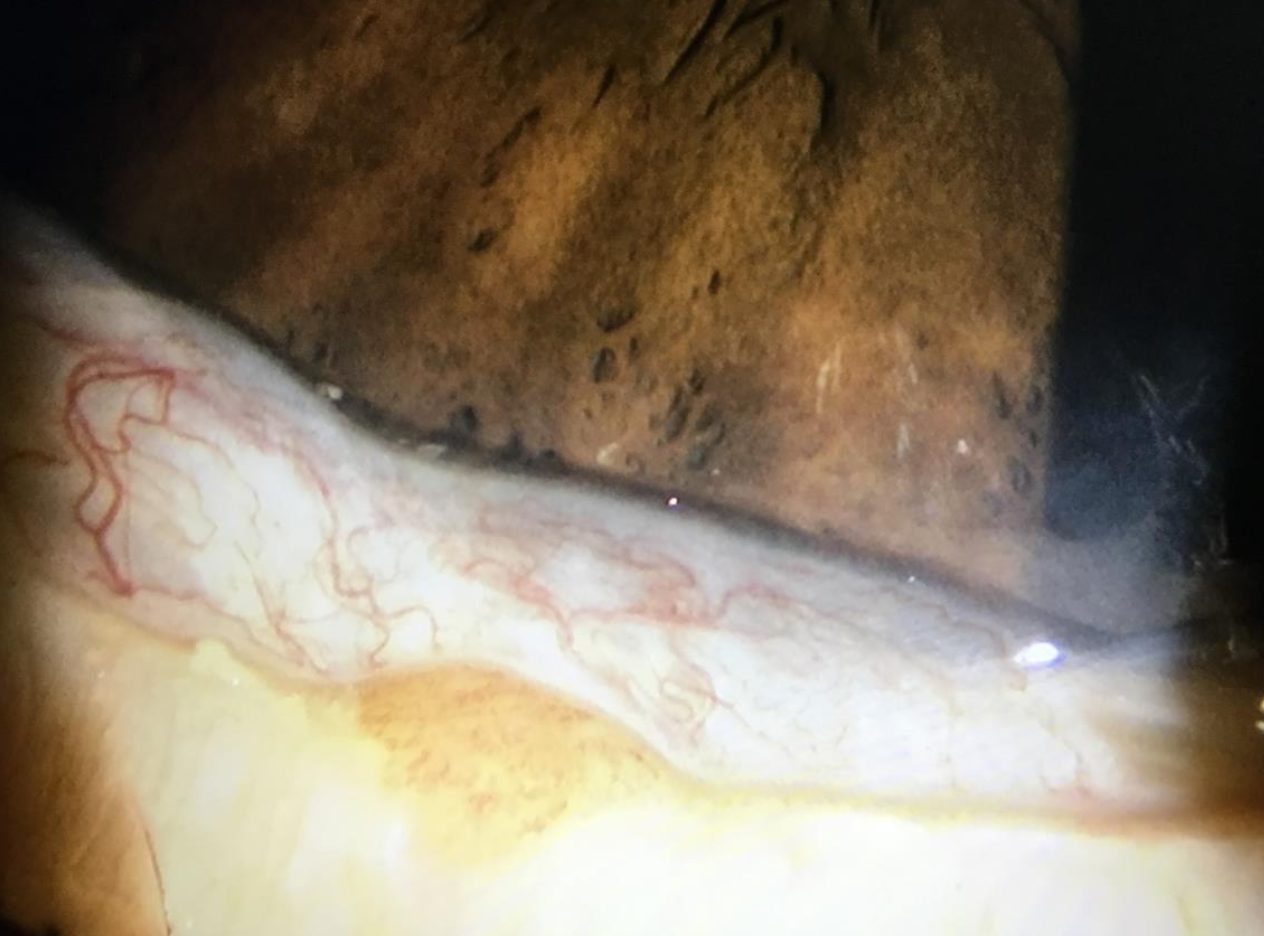下まぶた付近に結膜のひだがみられる結膜弛緩症の診察画像
