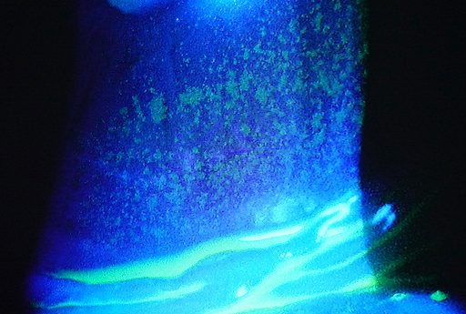 蛍光色素で涙液と結膜のひだを確認した画像