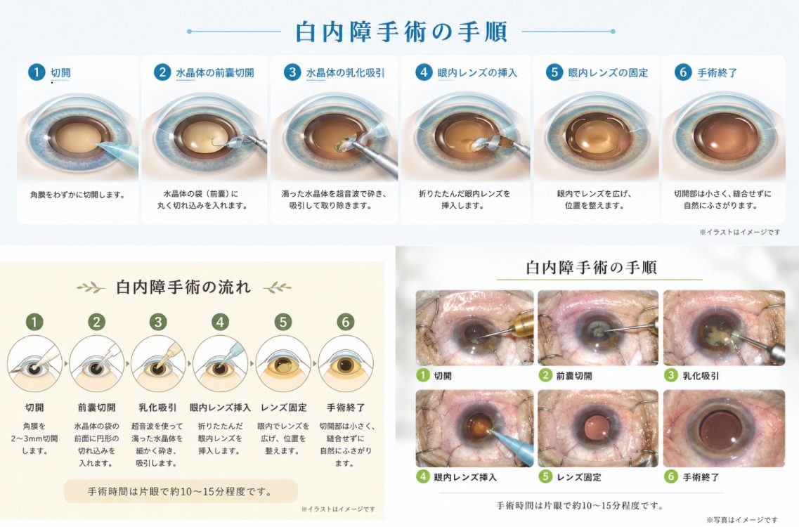 白内障手術の手順を説明する図
