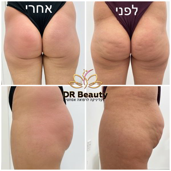 رفع الأرداف باستخدام VelaShape