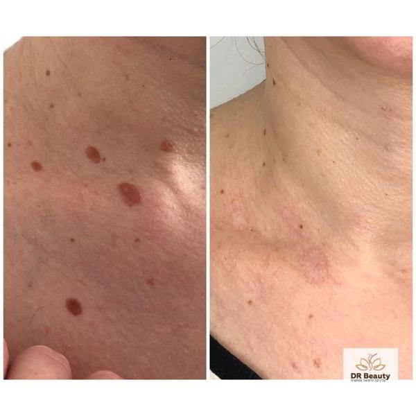 إزالة الورم الغدي
