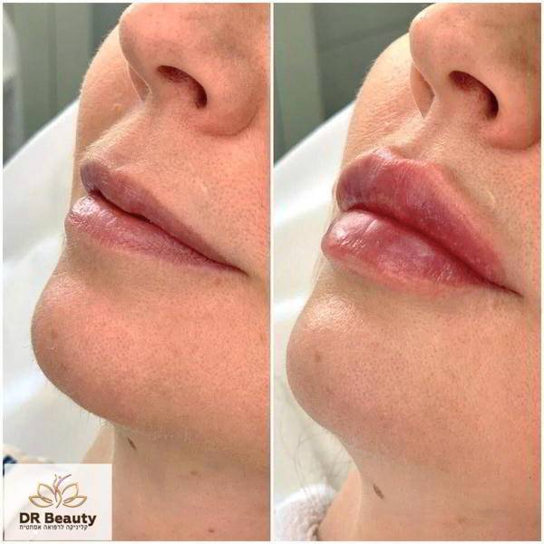 حقن التجميل - لماذا معنا