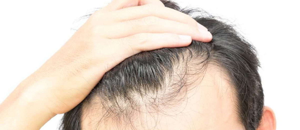 كيفية التخلص من تساقط الشعر