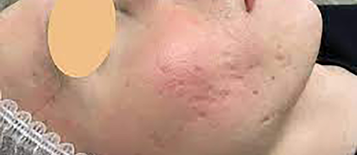 كيف تتخلص من آثار حب الشباب (Post-Acne)؟