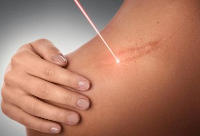 الندوب الضُمورية (Hypotrophic Scars)