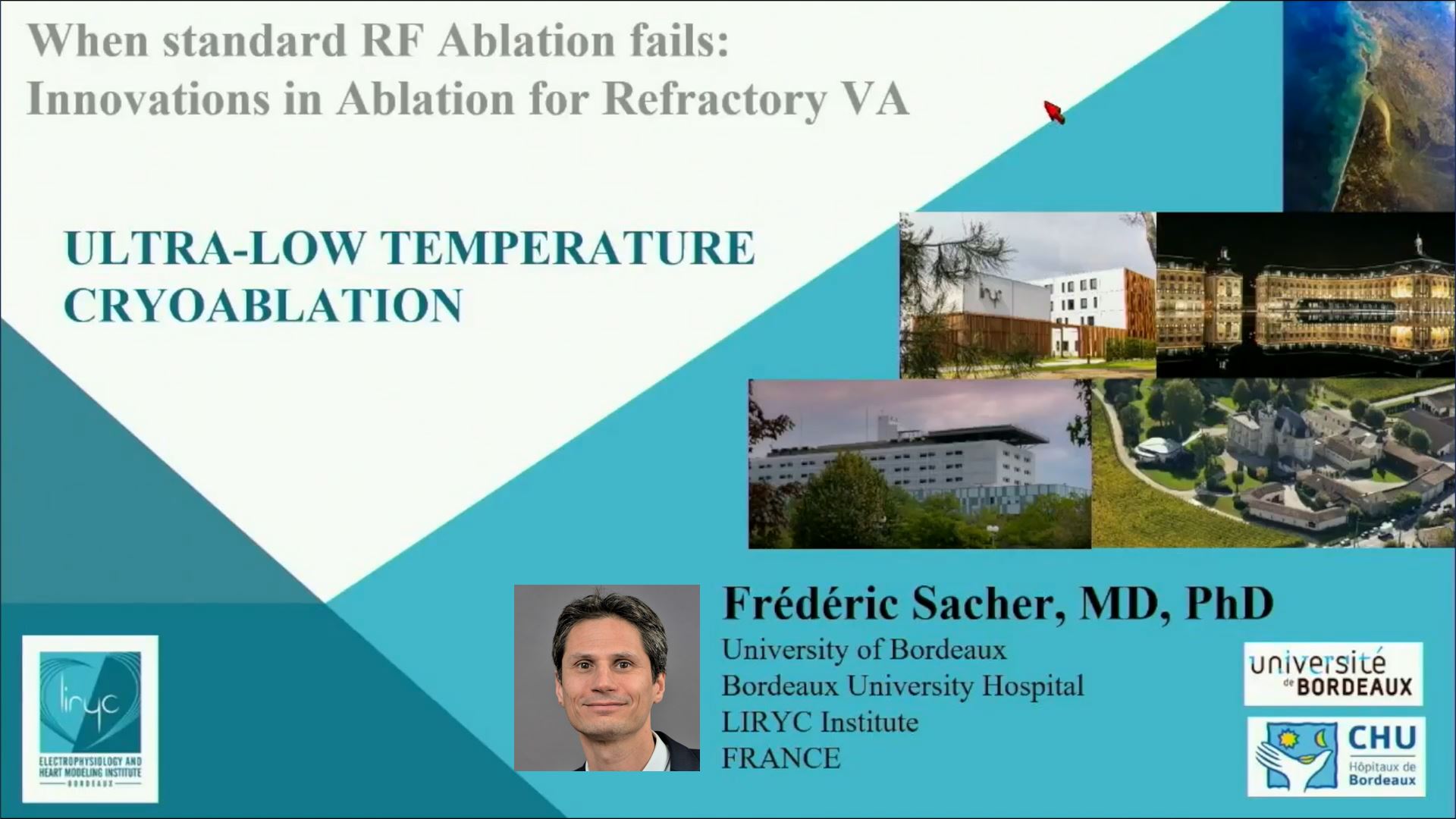 Innovations in Ablation for Refractory VA: Ultra-Low Temperature Cryoablation