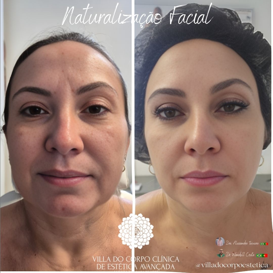 Antes e Depois Rosto