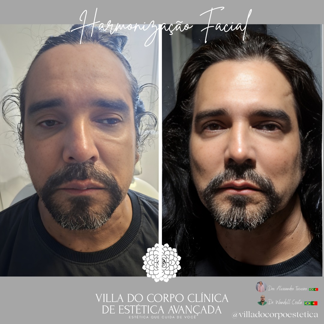 Antes e Depois Rosto Perfil