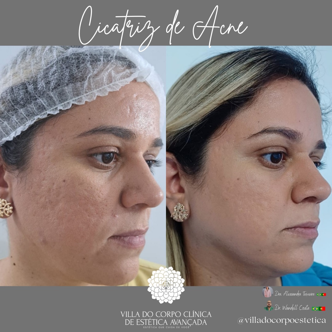 Tratamento Cicatriz de Acne