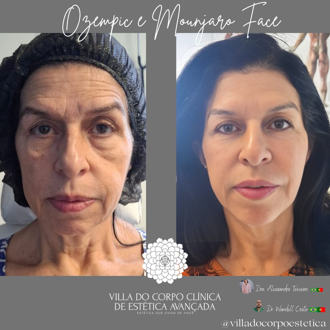 Tratamento Ozempic Face