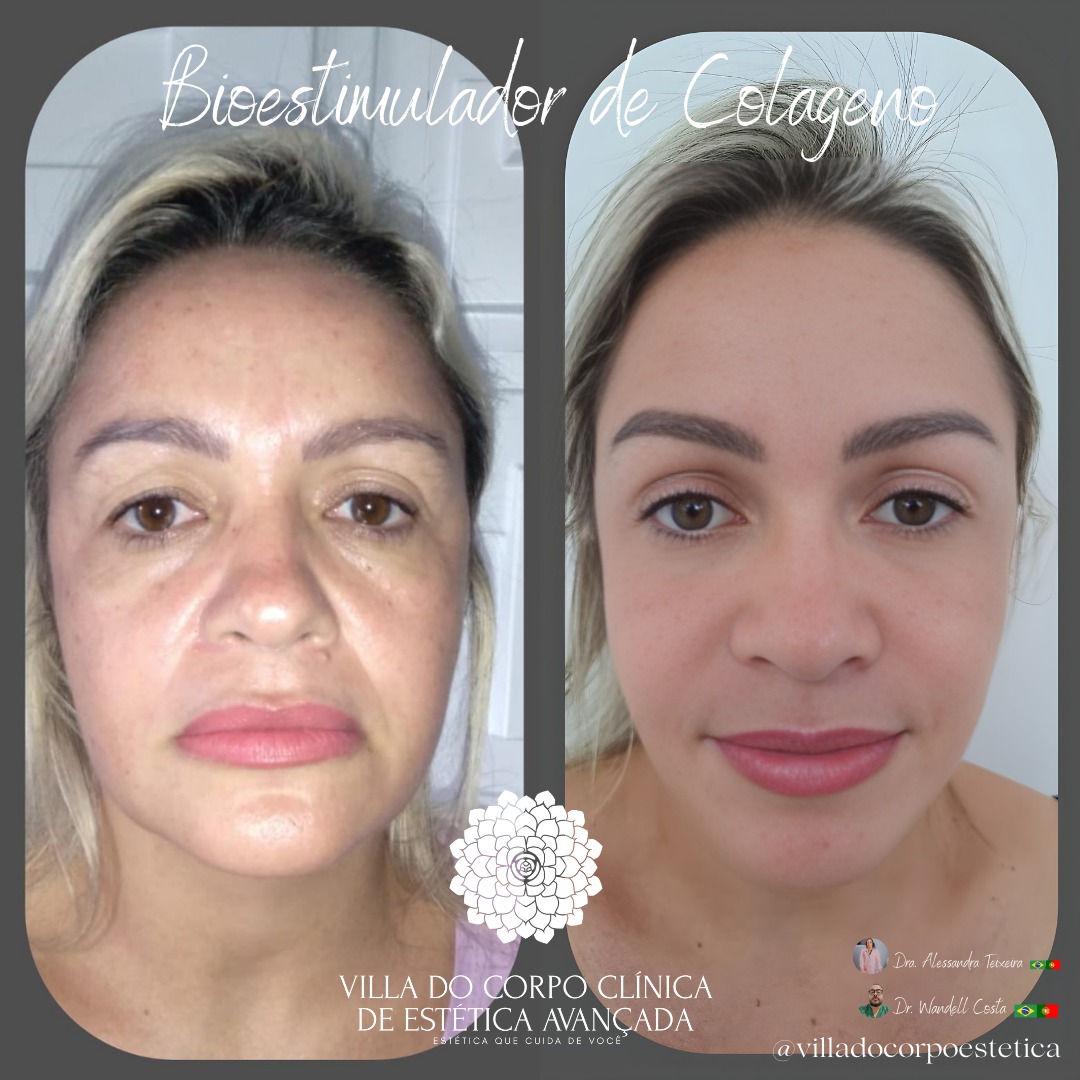 Resultado Facial