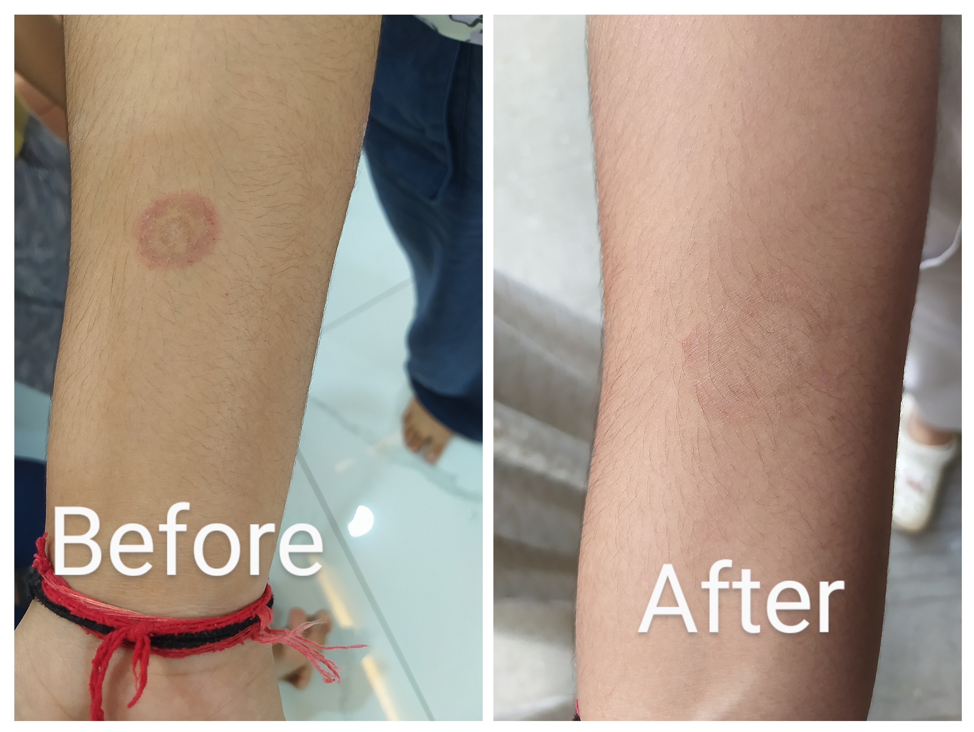 A case of ringworm cured within 7 days