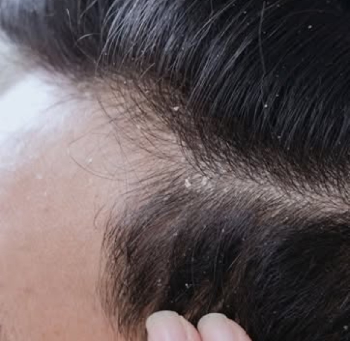 DANDRUFF

it is a common condition that causes the skin on the scalp to flake. It is not a serious condition But it can be embarrassing and difficult to treat.

Mild dandruff can be treated with a gentle daily shampoo.

If that doesn't works a medicated shampoo may help.

НОМОЕOPATHIC MEDICINE

◇Kali Muriaticum

◇Natrum Muriaticum

