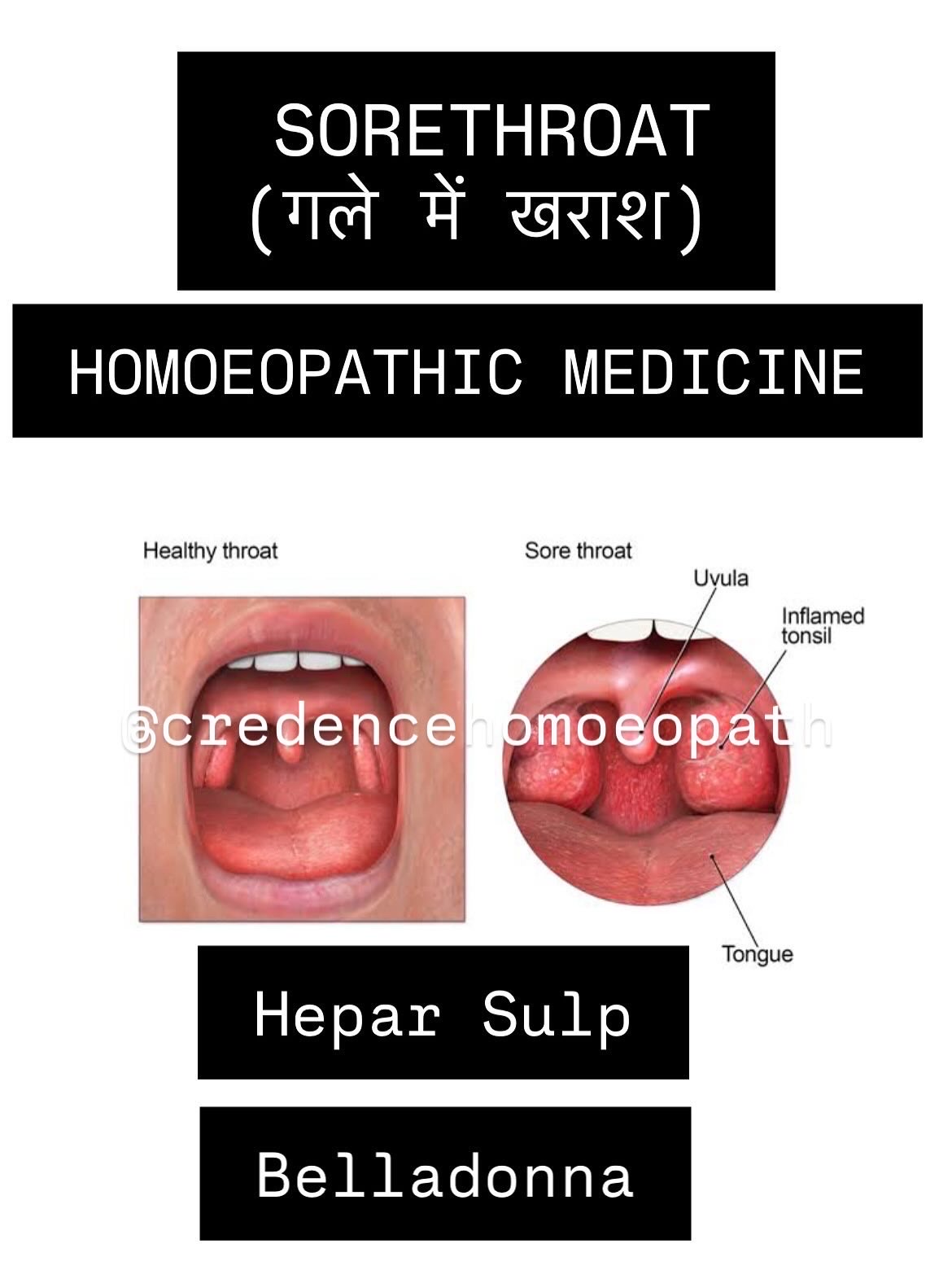 Tonsillitis is usually caused by a viral infection but can be from a bacterial infection.

Symptoms include sore throat, difficulty swallowing and tender lymph nodes 

