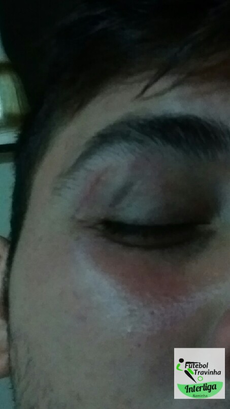 INTERLIGA - Nem ficou roxo kk