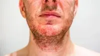 La dermatite séborrhéique : bénigne, gênante et persistante