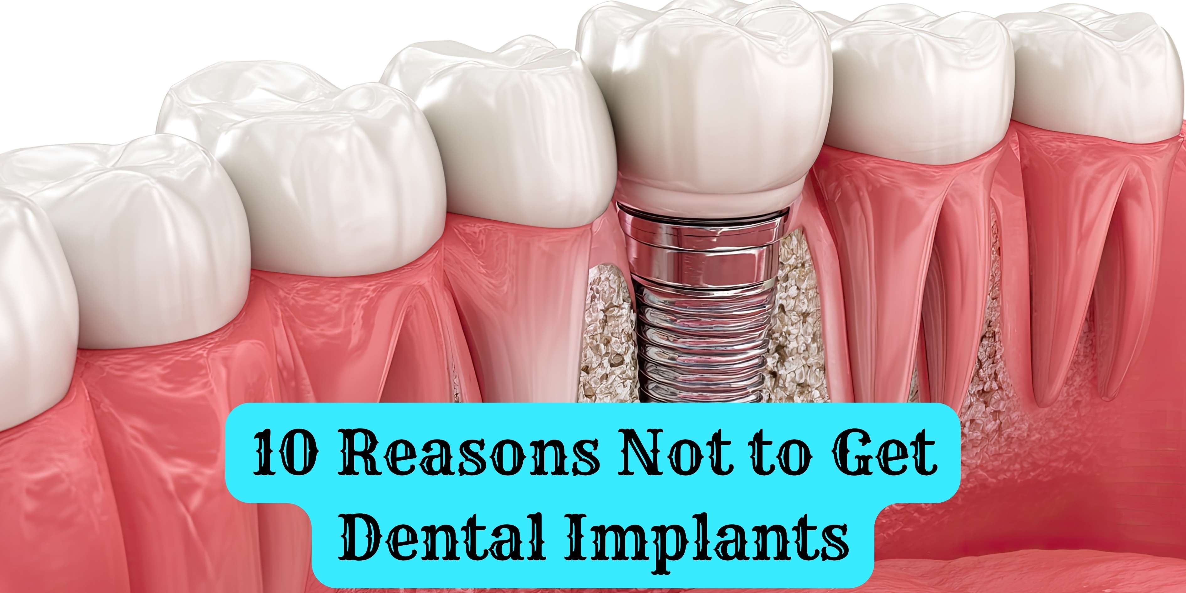 10 Reasons Not to Get Dental Implants